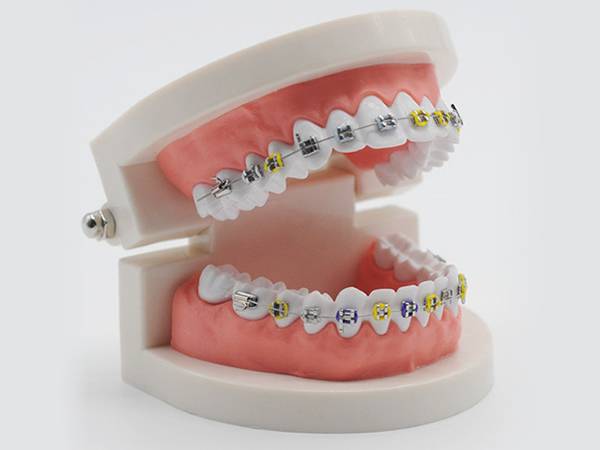 Two lines of archwires are fastened onto the teeth with brackets.